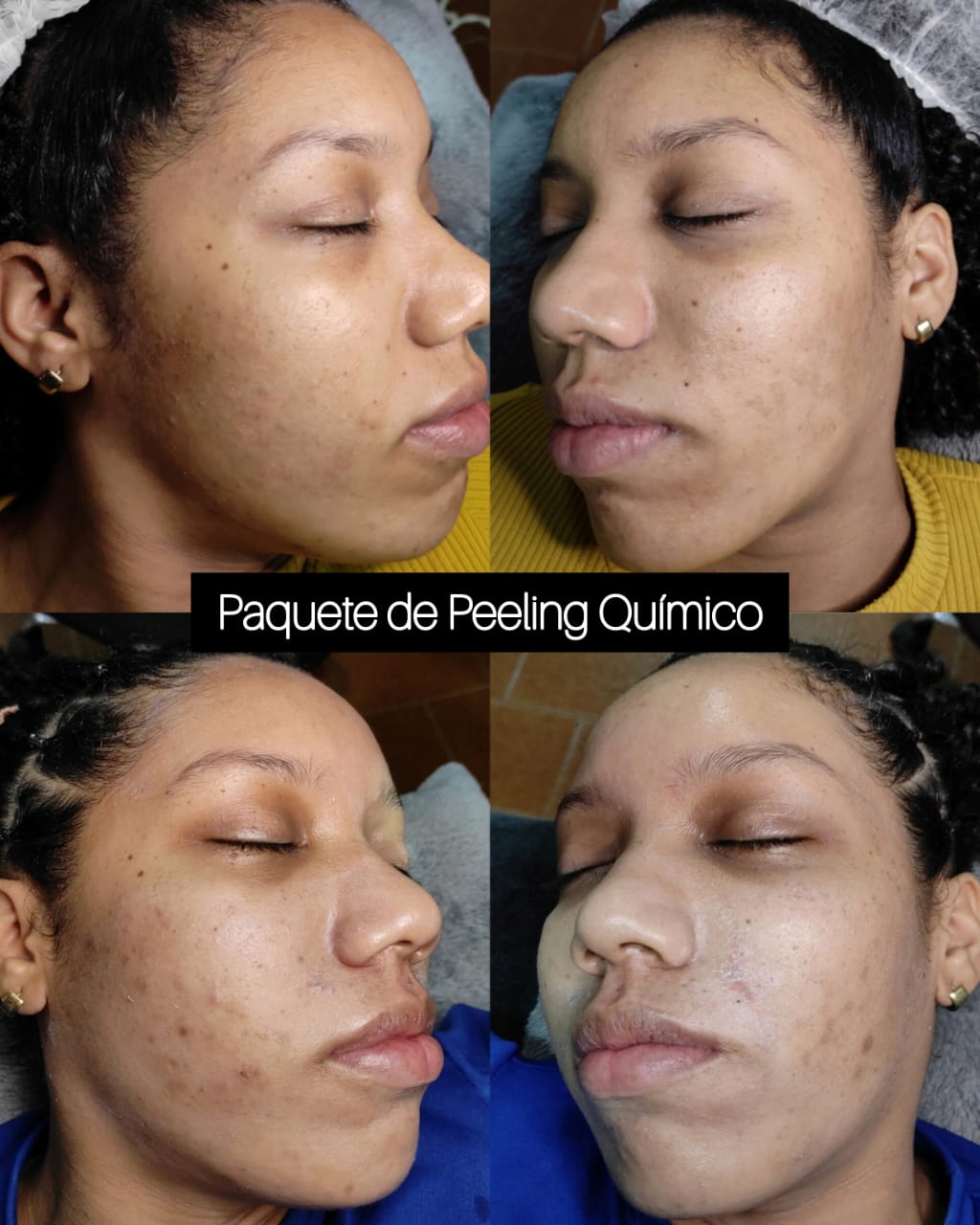 Tratamientos Faciales